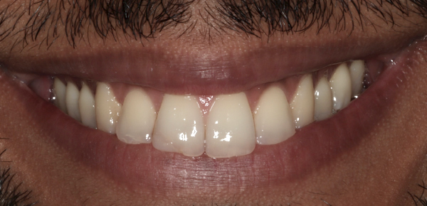 Huz Before Invisalign treatment in Wimbledon